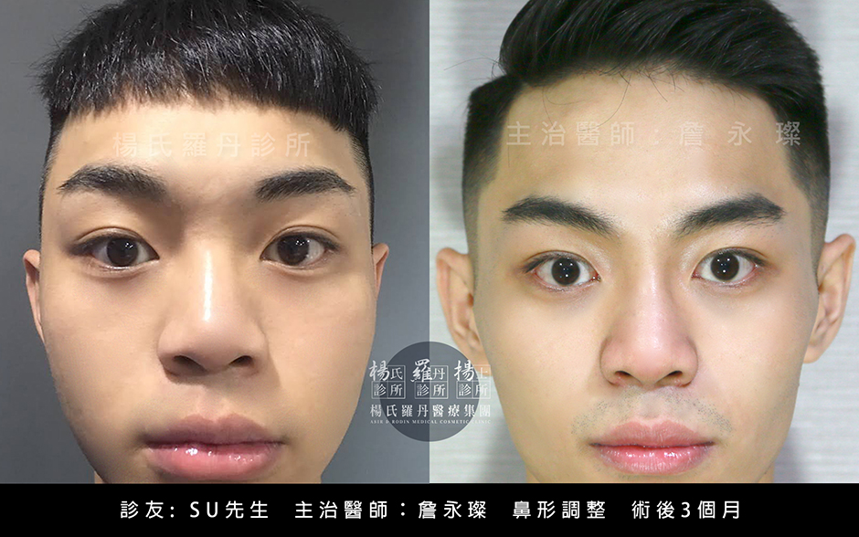 醫學美容 調整鼻形  楊氏羅丹 挺鼻